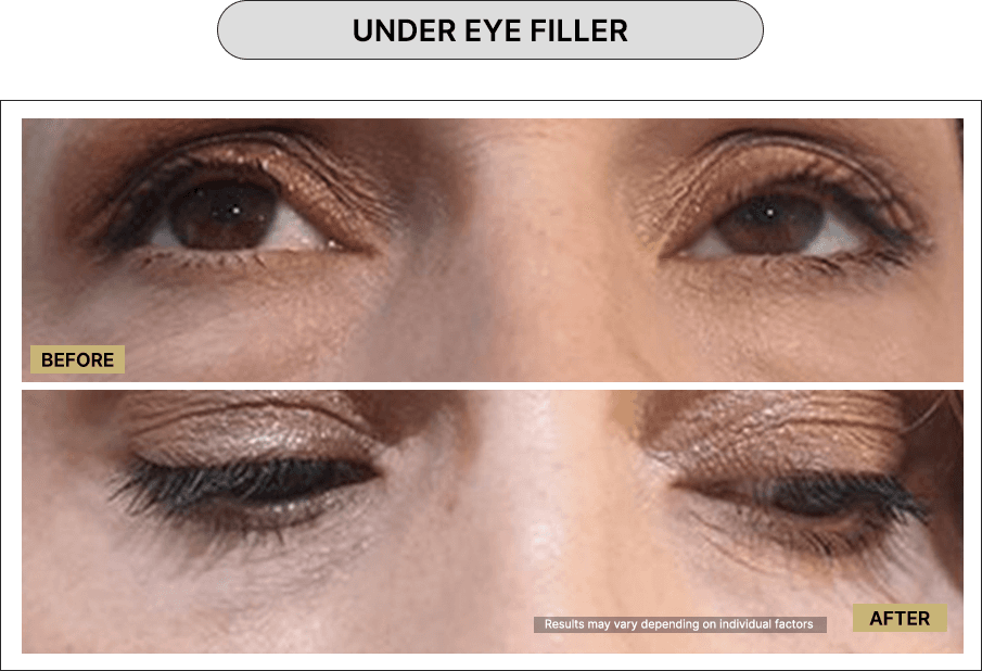 Under Eye Filler