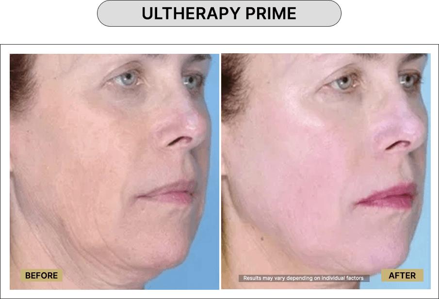 Ultherapy Prime