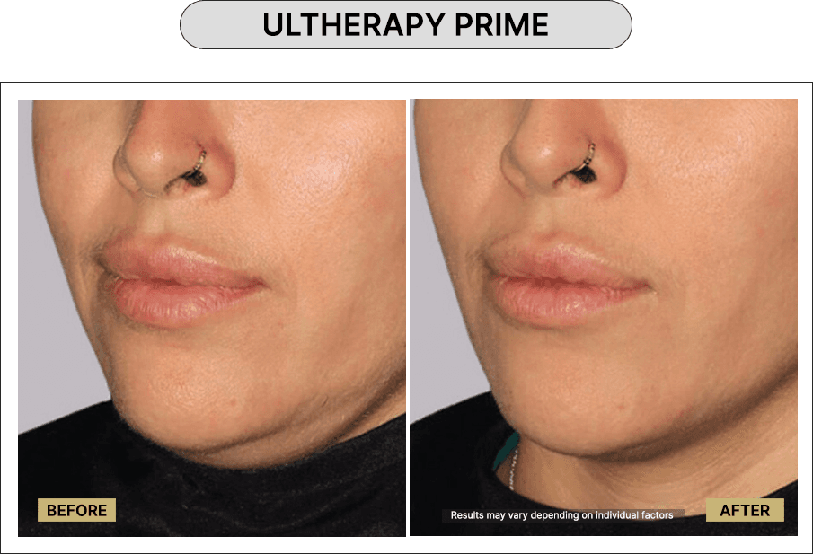 Ultherapy Prime