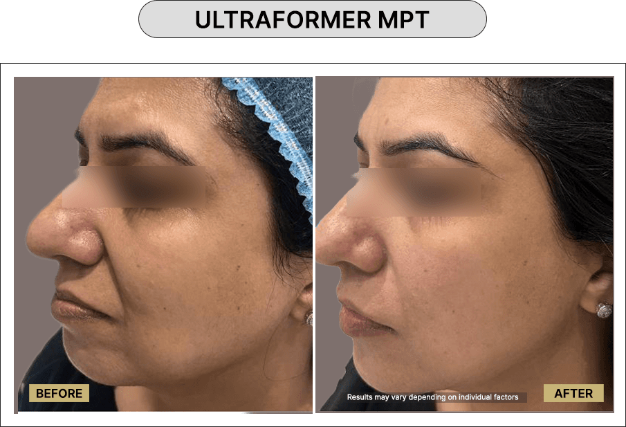 Ultraformer MPT