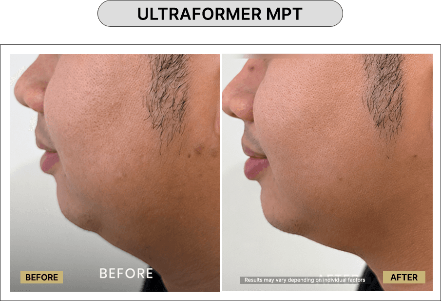 Ultraformer MPT