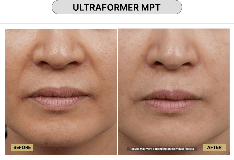 Ultraformer MPT