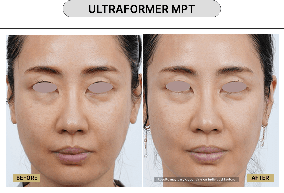 Ultraformer MPT