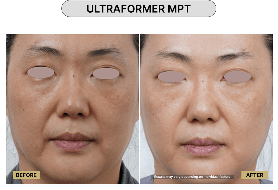 Ultraformer MPT