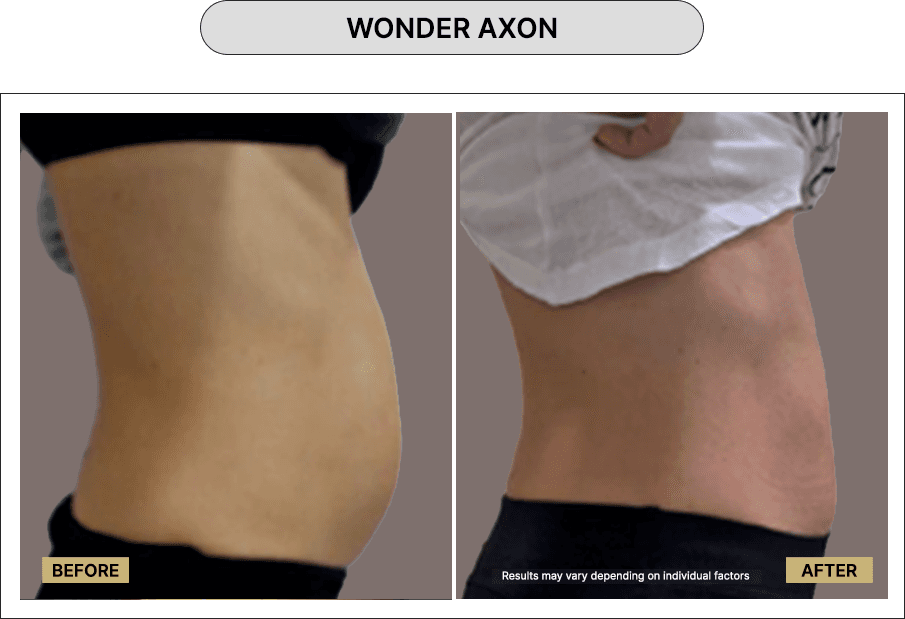 Wonder Axon