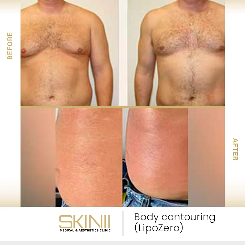 Before and after results of LipoZero body contouring treatment at SKIN111 Dubai -2
