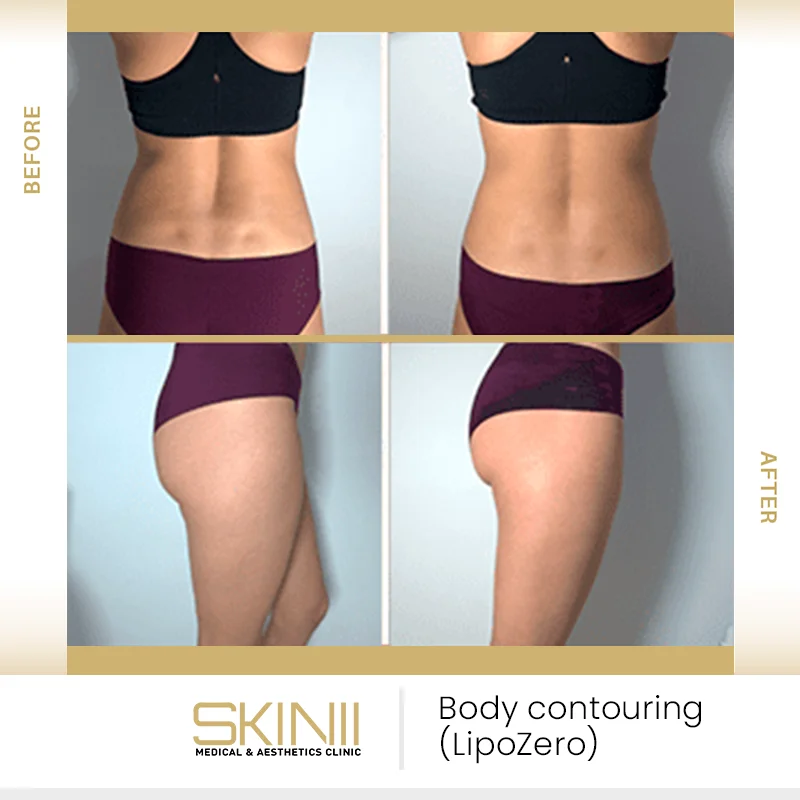 Before and after results of LipoZero body contouring treatment at SKIN111 Dubai - 3
