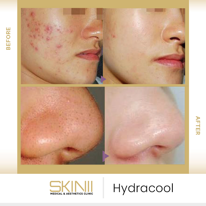Hydracool Facial In Dubai UAE Advanced Skin Rejuvenation Skin111 Hydracool Facial In Dubai UAE Advanced Skin Rejuvenation Skin111
