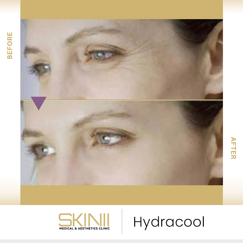 Hydracool Facial In Dubai UAE Advanced Skin Rejuvenation Skin111 Hydracool Facial In Dubai UAE Advanced Skin Rejuvenation Skin111