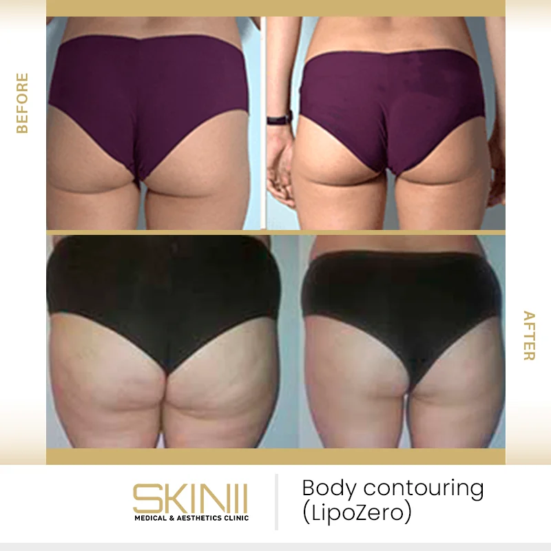 Before and after results of LipoZero body contouring treatment at SKIN111 Dubai - 4