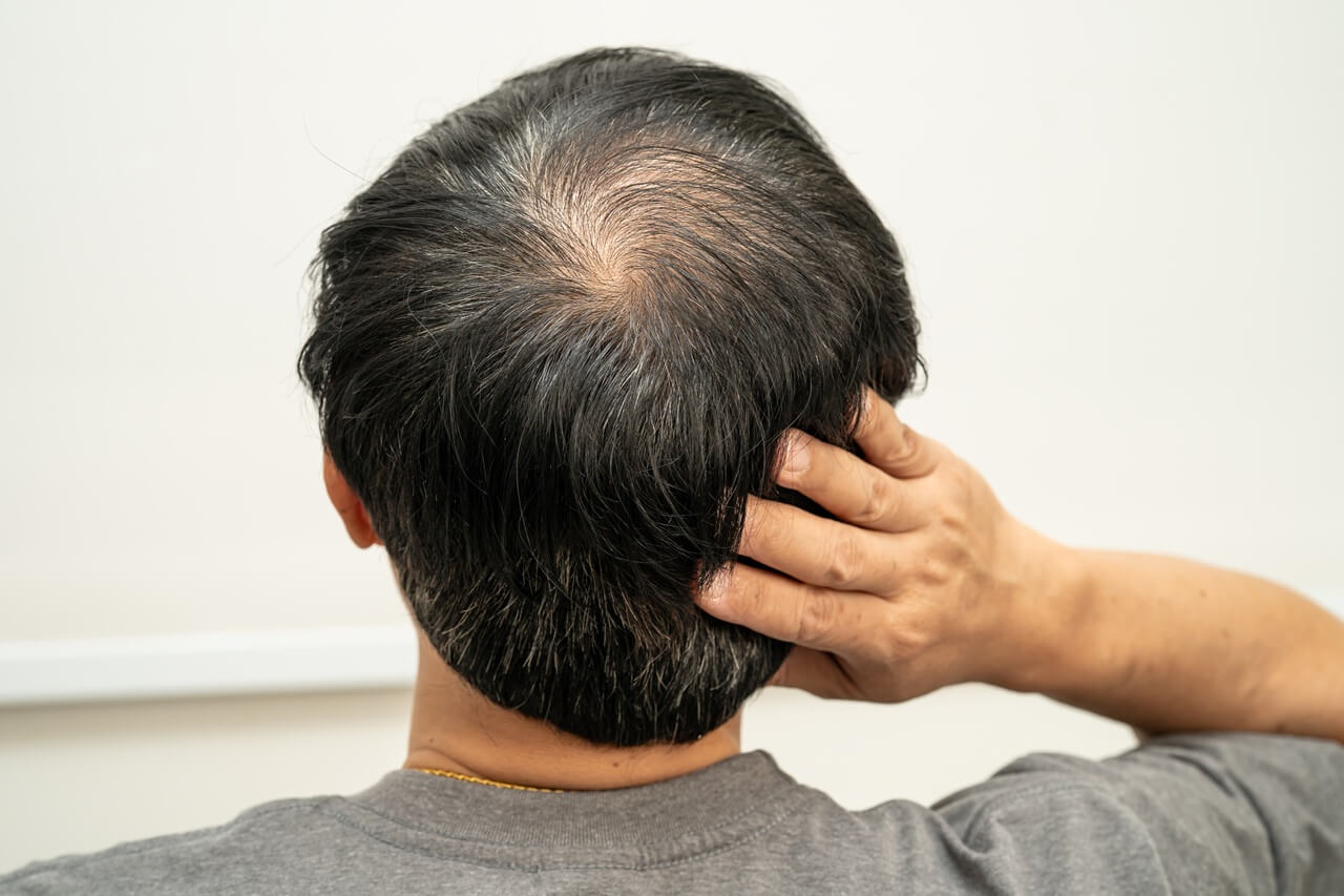 How Regenerative Therapies are Redefining Hair Growth? A Comprehensive Guide