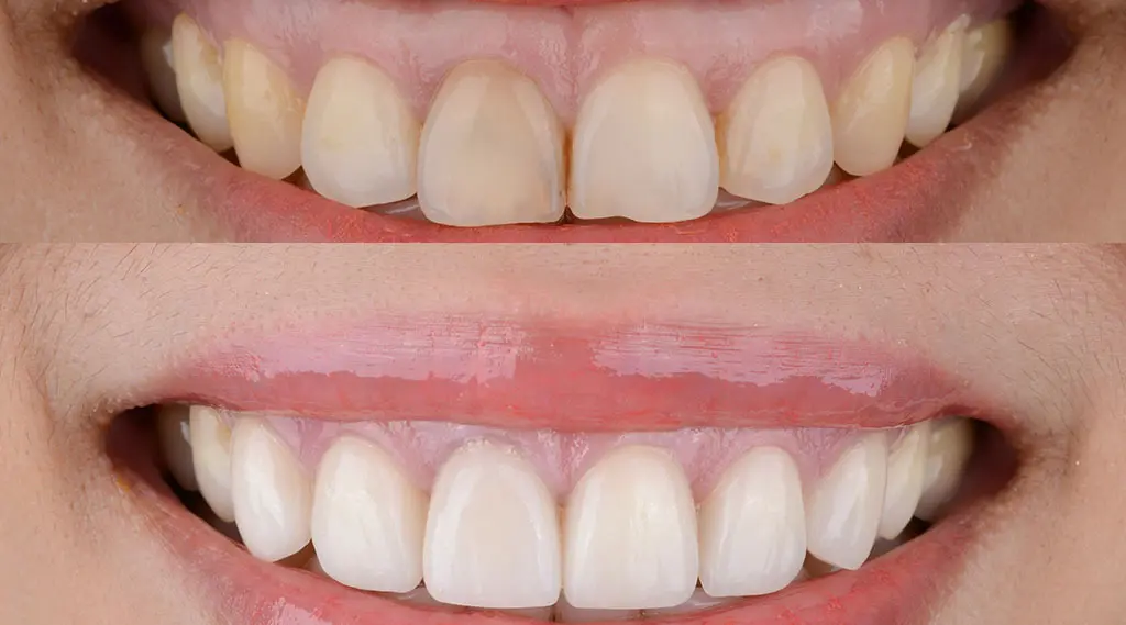 Gummy Smile Correction: A Path Towards Improved Confidence and Health