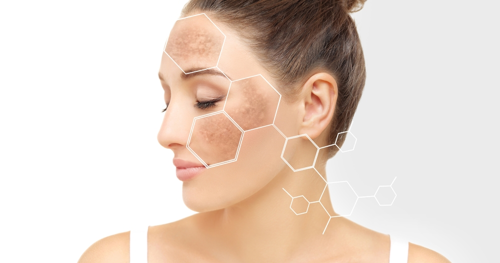 Hyperpigmentation Treatment Causes and Types
